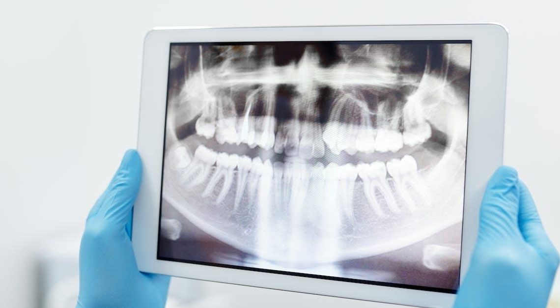 Sådan kan røntgensoftware hjælpe tandlæger med at behandle patienter